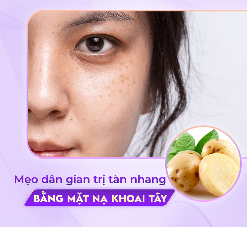 mặt nạ khoai tây giúp trị tàn nhang hiệu quả