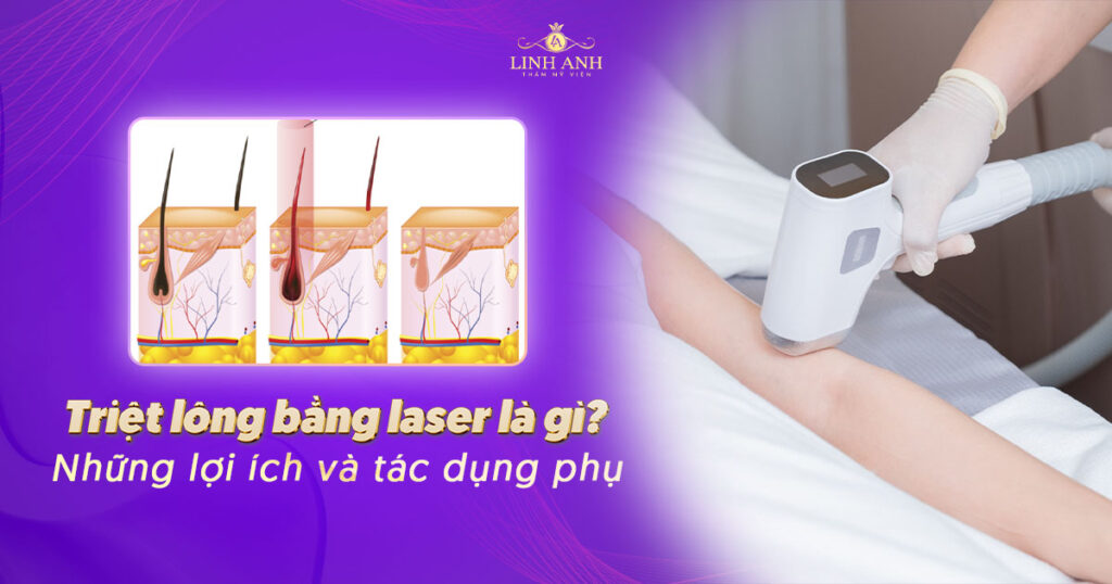 triệt lông bằng laser