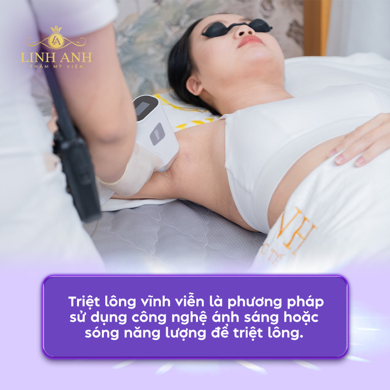 Triệt lông bao nhiêu lần thì hết sạch Triệt lông bao nhiêu lần thì hết sạch
