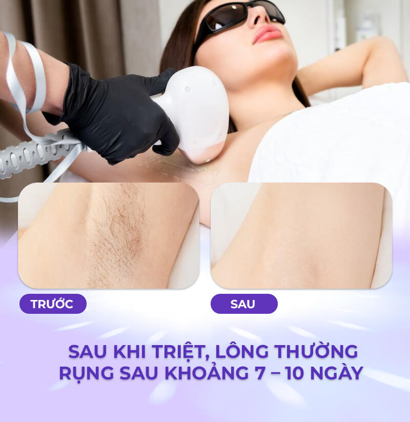 Triệt lông bao nhiêu lâu thì rụng Triệt lông bao nhiêu lâu thì rụng