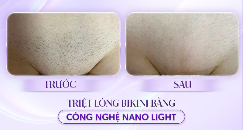Triệt lông bikini bằng công nghệ nano light