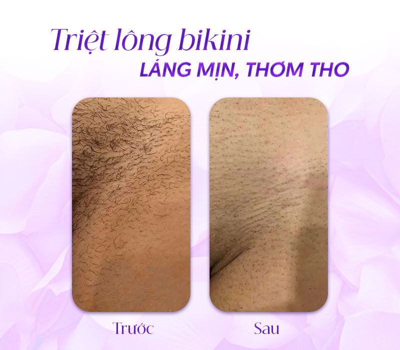 triệt lông bikini bao nhiêu tiền triệt lông bikini bao nhiêu tiền
