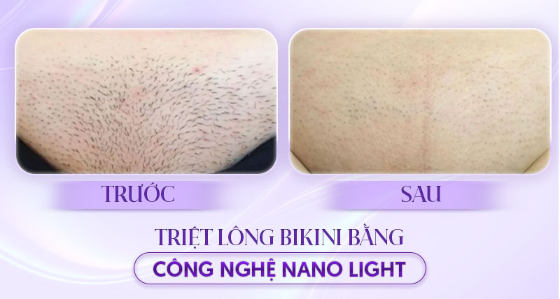 Triệt lông bikini có ảnh hưởng gì không