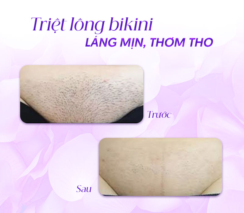 triệt lông bikini giá bao nhiêu triệt lông bikini giá bao nhiêu