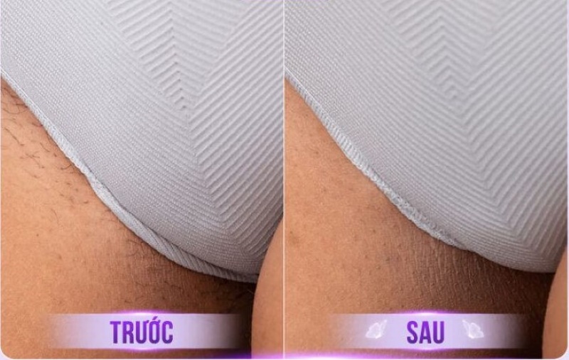 triệt lông bikini xong sẽ như thế nào