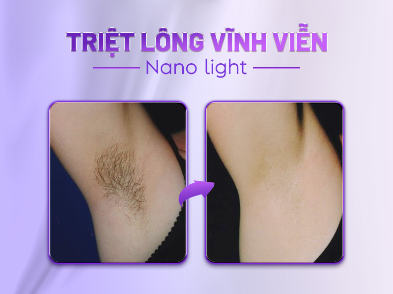 triệt lông có hết vĩnh viễn được không triệt lông có hết vĩnh viễn được không