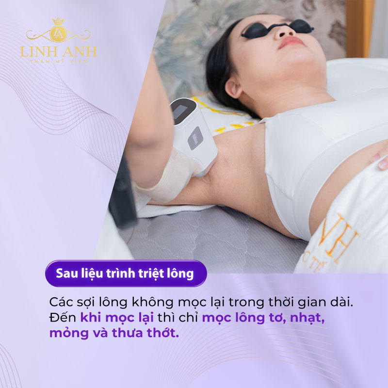 triệt lông có mọc lại không triệt lông có mọc lại không
