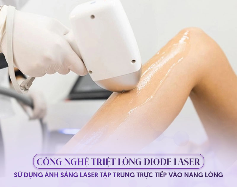 triệt lông công nghệ diode laser