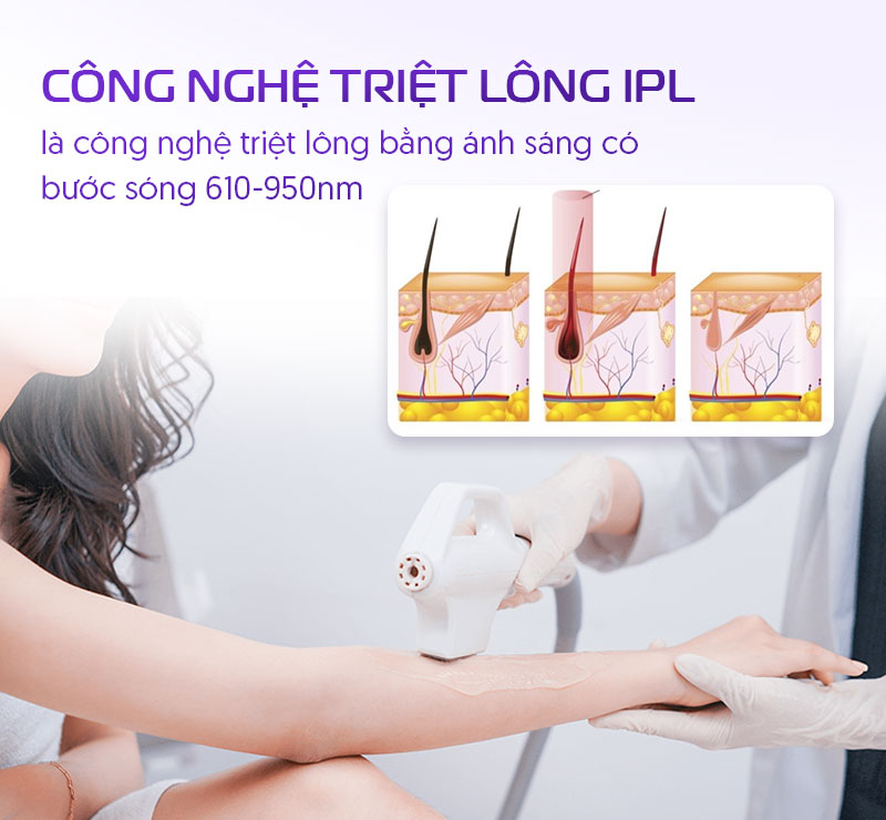 triệt long công nghệ IPL triệt long công nghệ IPL