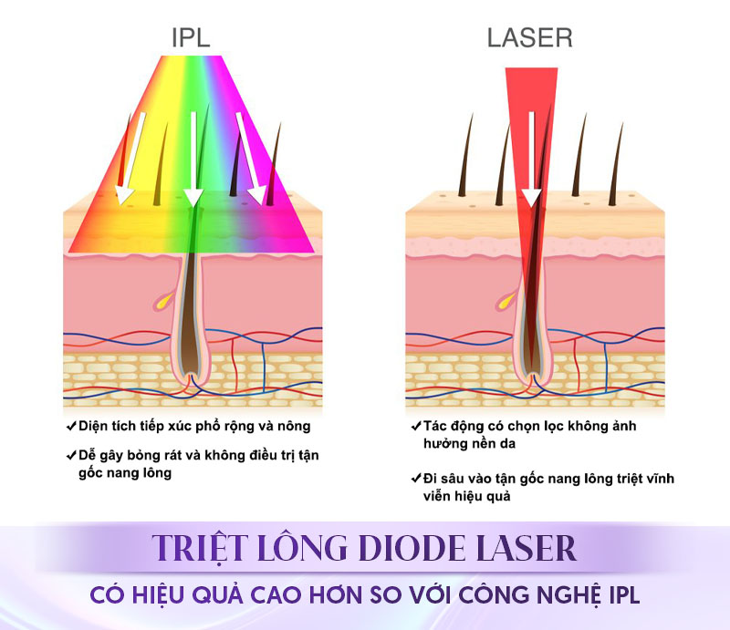 triệt lông diode laser là gì