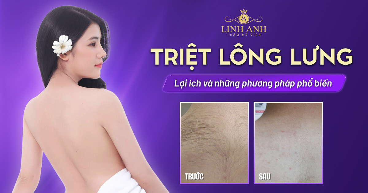Triệt lông lưng – Lợi ích và những phương pháp phổ biến