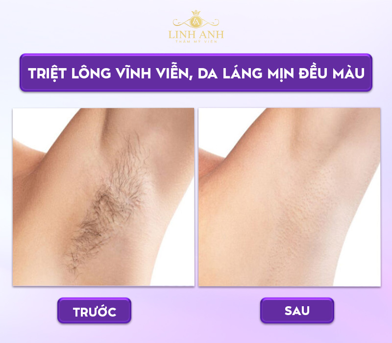 Triệt lông nách có đau không