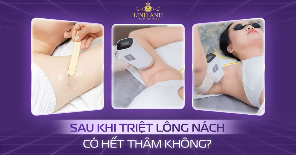 triệt lông nách có hết thâm không