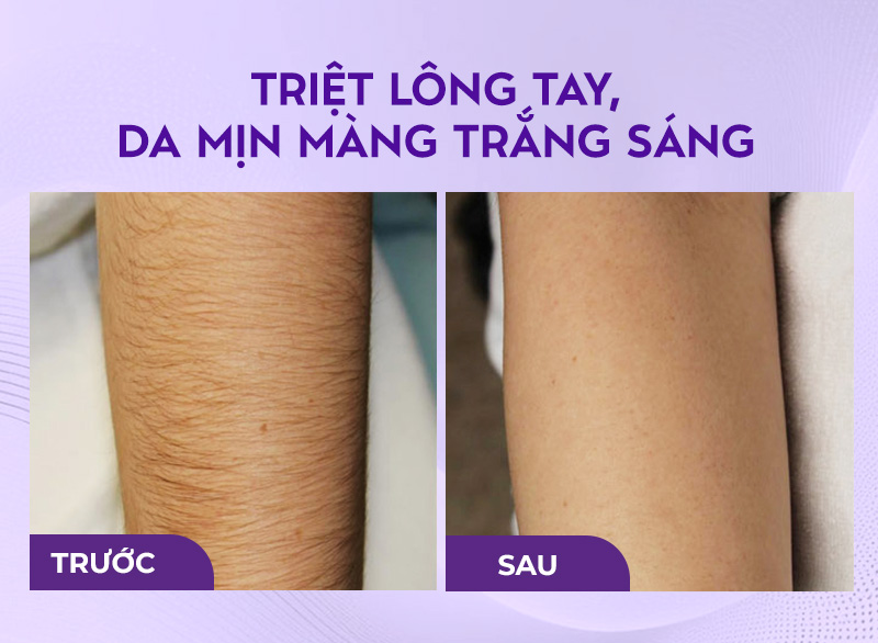 triệt lông ở bệnh viện da liễu bao nhiêu triệt lông ở bệnh viện da liễu bao nhiêu