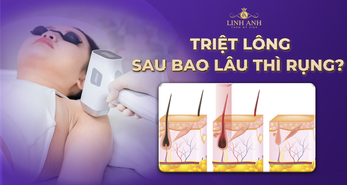 Triệt lông sau bao lâu thì rụng? Các yếu tố ảnh hưởng là gì?