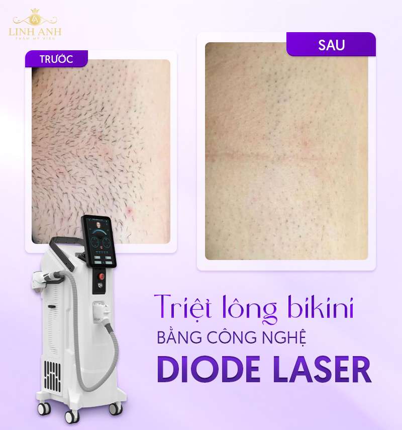 Triệt lông vùng kín nữ Diode laser
