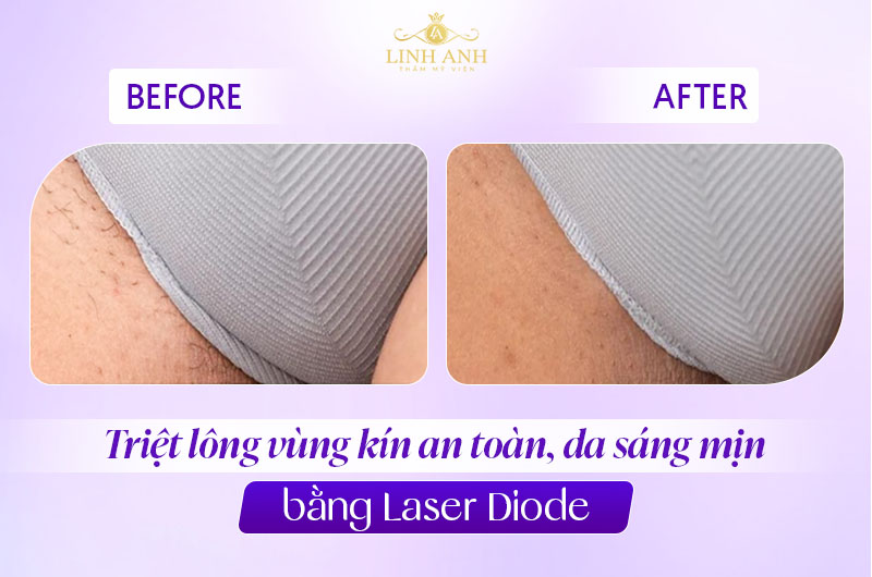 Triệt lông vùng kín trước và sau