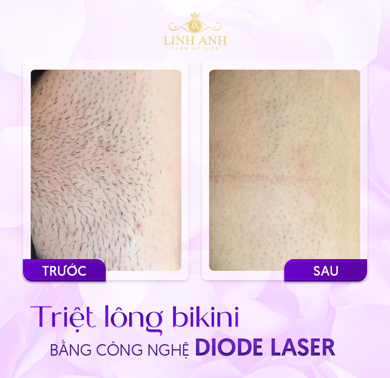 Triệt lông vùng kín trước và sau