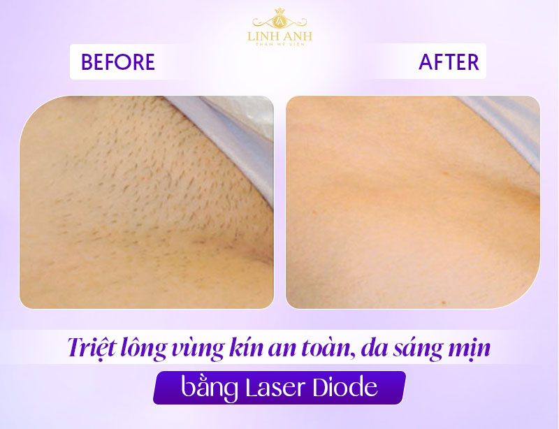 Triệt lông vùng kín vĩnh viễn nữ