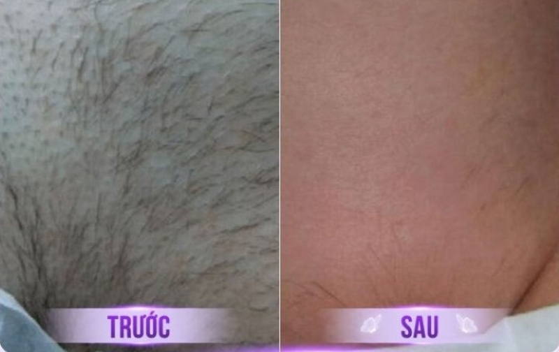 trước và sau khi triệt lông vùng kín