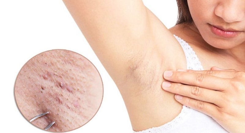 vì sao nhổ lông nách bị nổi hạch vì sao nhổ lông nách bị nổi hạch