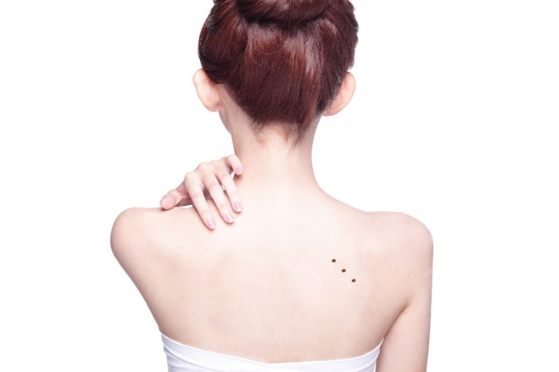 3 Nốt ruồi thẳng hàng