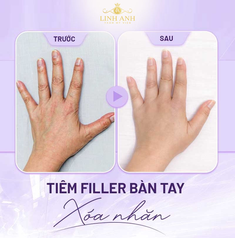 Review trẻ hóa bàn tay Review trẻ hóa bàn tay