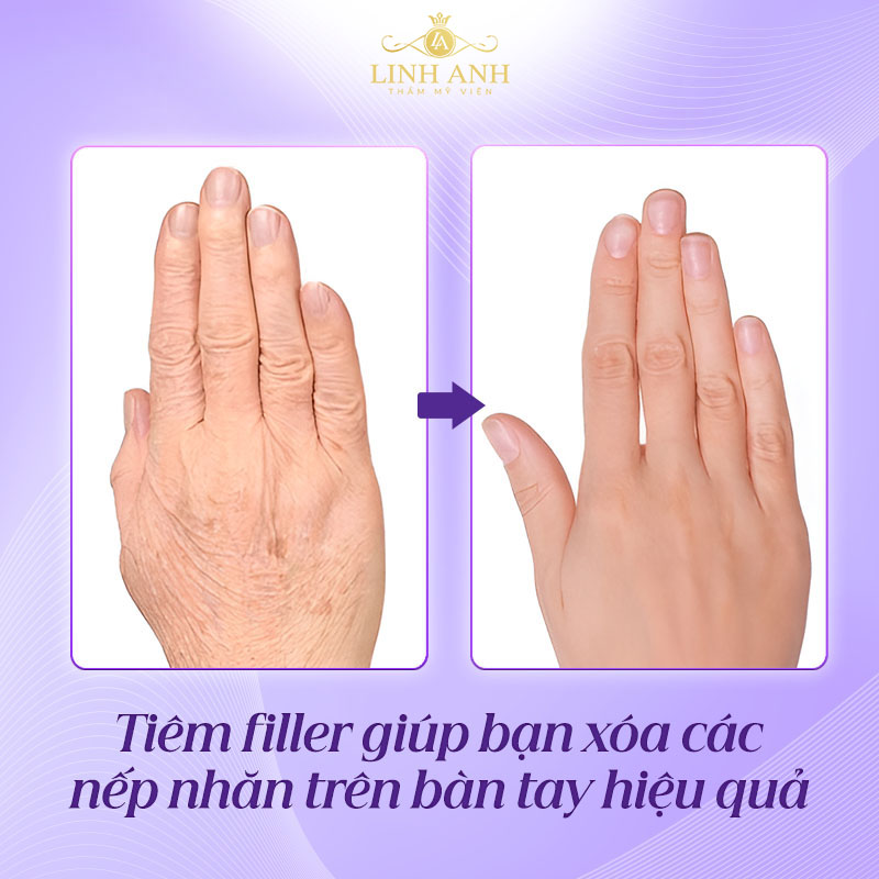 Tiêm làm đầy mu bàn tay Tiêm làm đầy mu bàn tay