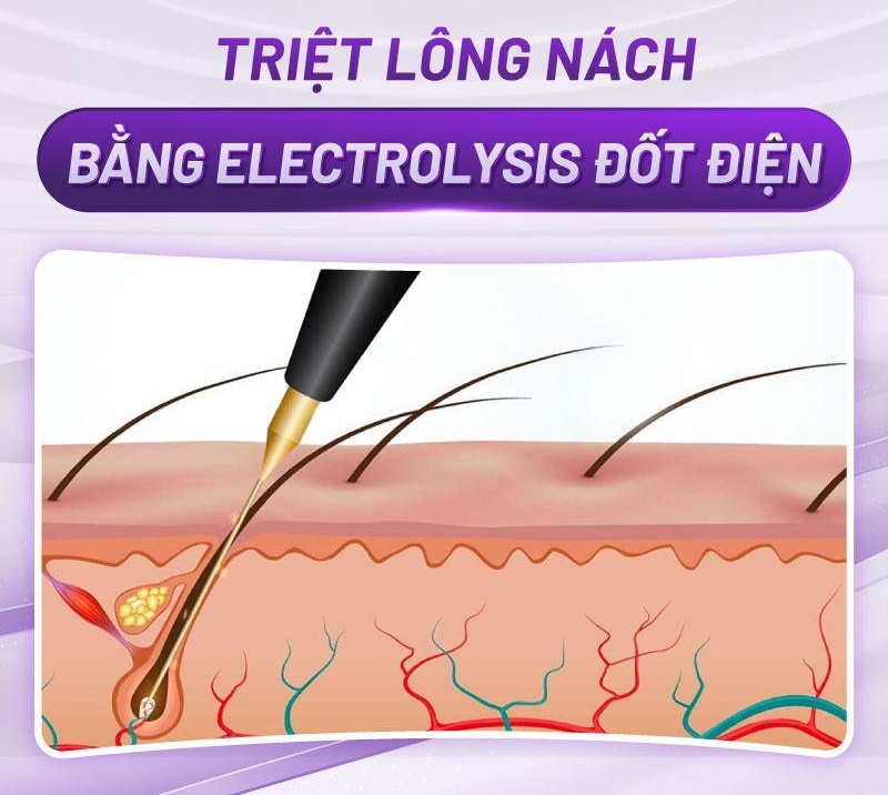 triệt lông nách hiệu quả triệt lông nách hiệu quả