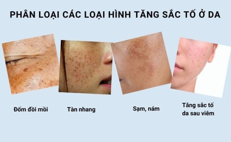 Bị tăng sắc tố da ở mặt