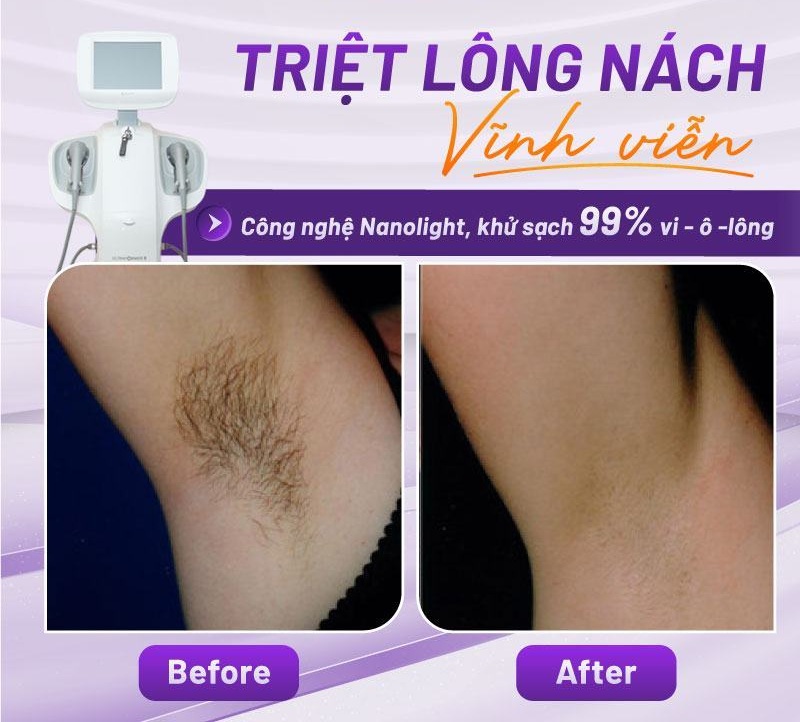 các cách triệt lông nách các cách triệt lông nách