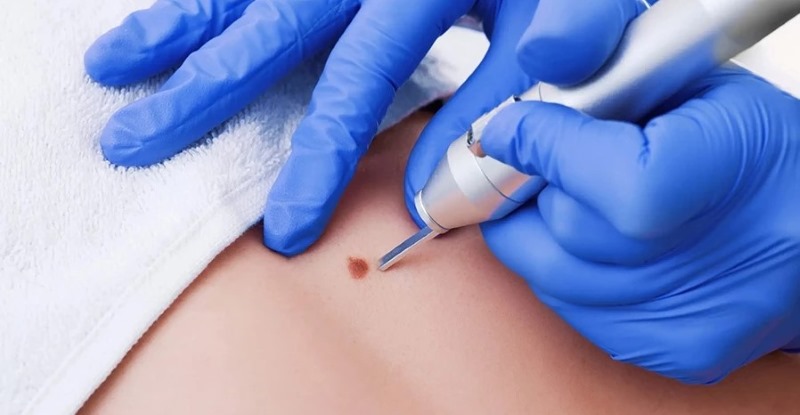 Cách tẩy nốt ruồi laser