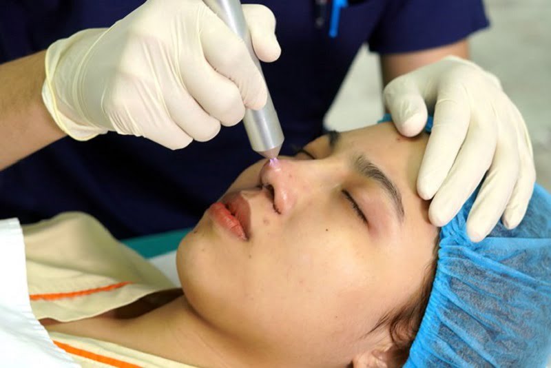 Cách tẩy nốt ruồi plasma không bị sẹo