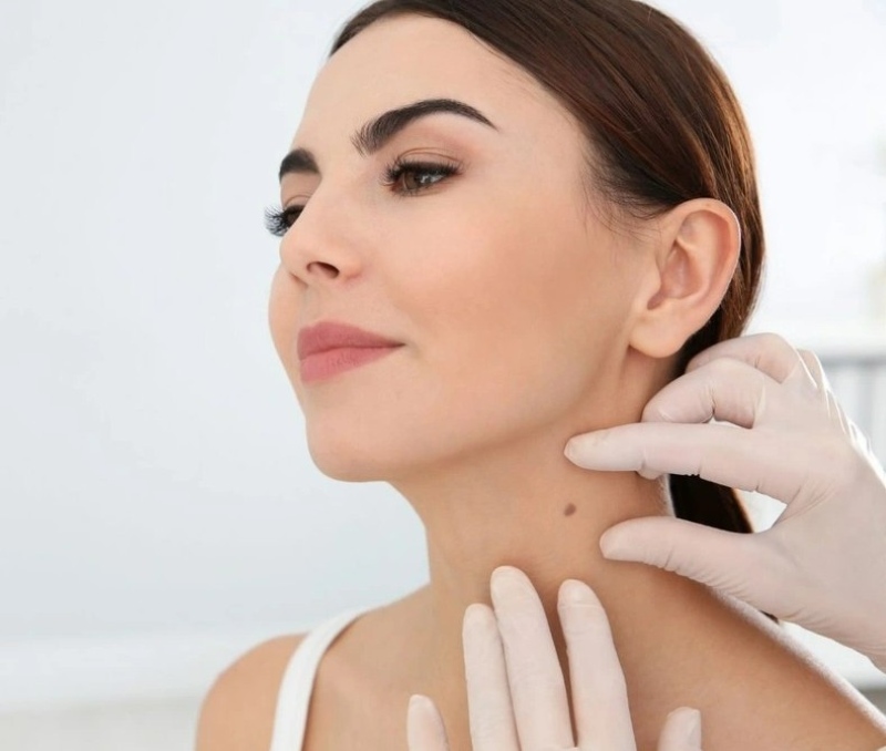 Cách tẩy nốt ruồi trong 1 ngày có thật không