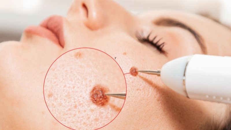 Cách xoá nốt ruồi Cách xoá nốt ruồi