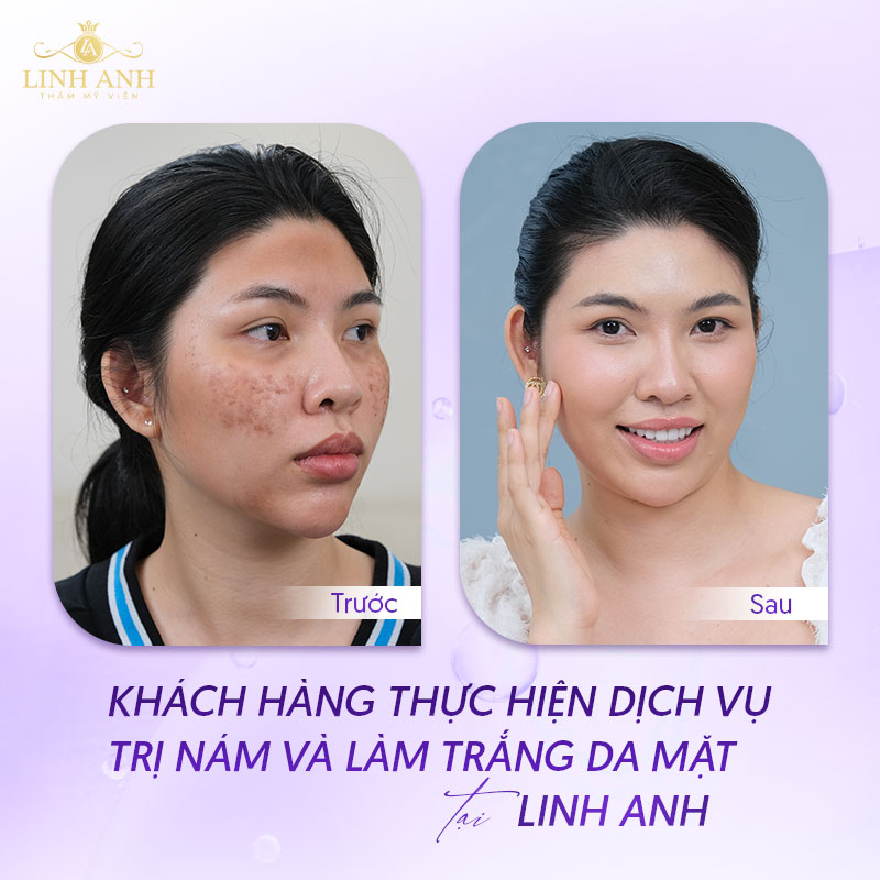 Cấy trắng da mặt giá bao nhiêu Cấy trắng da mặt giá bao nhiêu