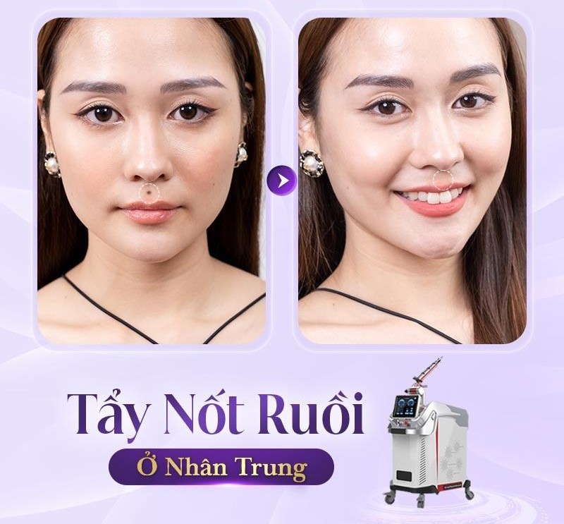 Có nên tẩy nốt ruồi ở nhân trung