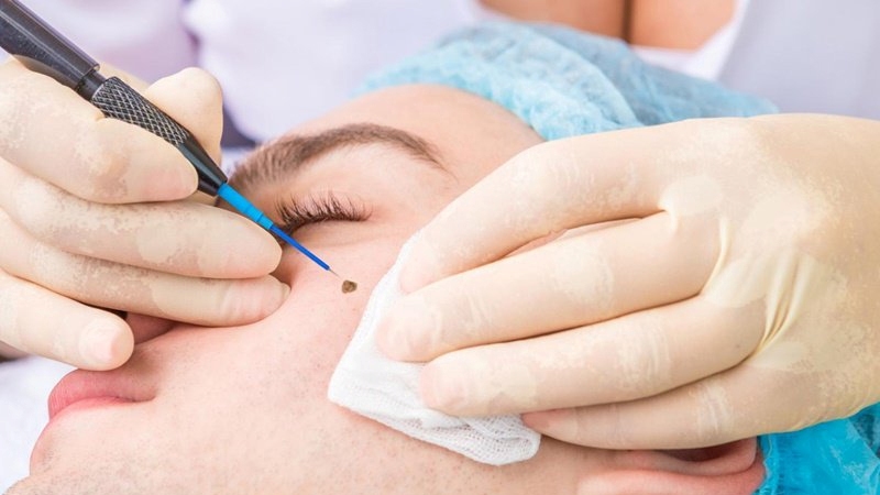 Có nên tẩy nốt ruồi trên mặt không