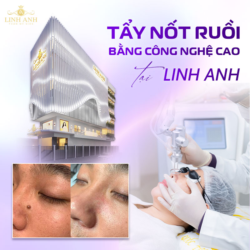 Công nghệ laser CO2 tẩy nốt ruồi nhanh chóng