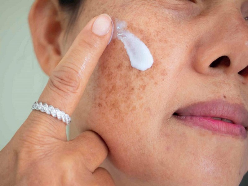 Da mặt bị tăng sắc tố phải làm sao