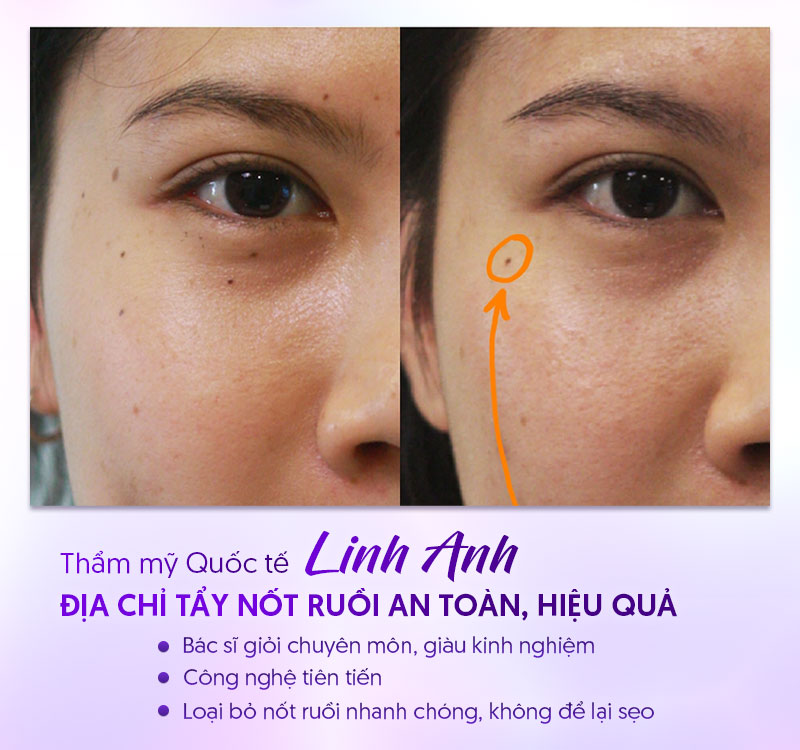 Địa chỉ tẩy nốt ruồi an toàn không để lại sẹo Địa chỉ tẩy nốt ruồi an toàn không để lại sẹo