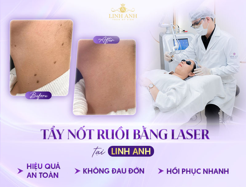 Địa chỉ tẩy nốt ruồi uy tín ở tphcm