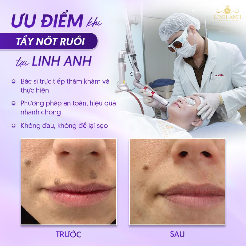 Địa chỉ tẩy nốt ruồi uy tín tại Tphcm - TMV Linh Anh