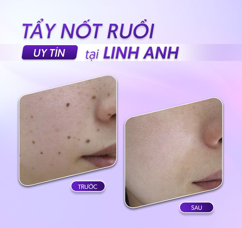 Địa chỉ tẩy xóa nốt ruồi hiệu quả-TMV LINH ANH