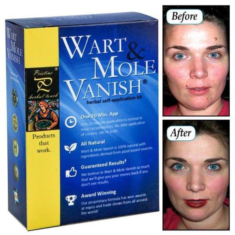 Gel tẩy nốt ruồi Wart and Mole Vanish