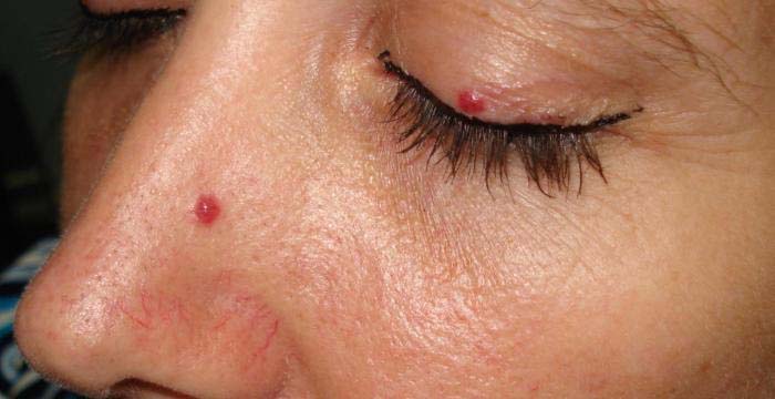 Nốt ruồi son trên mặt Nốt ruồi son trên mặt