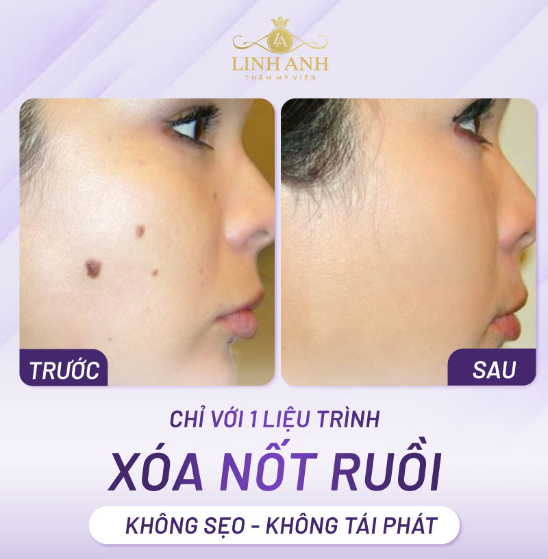 Hình ảnh tẩy nốt ruồi bằng laser