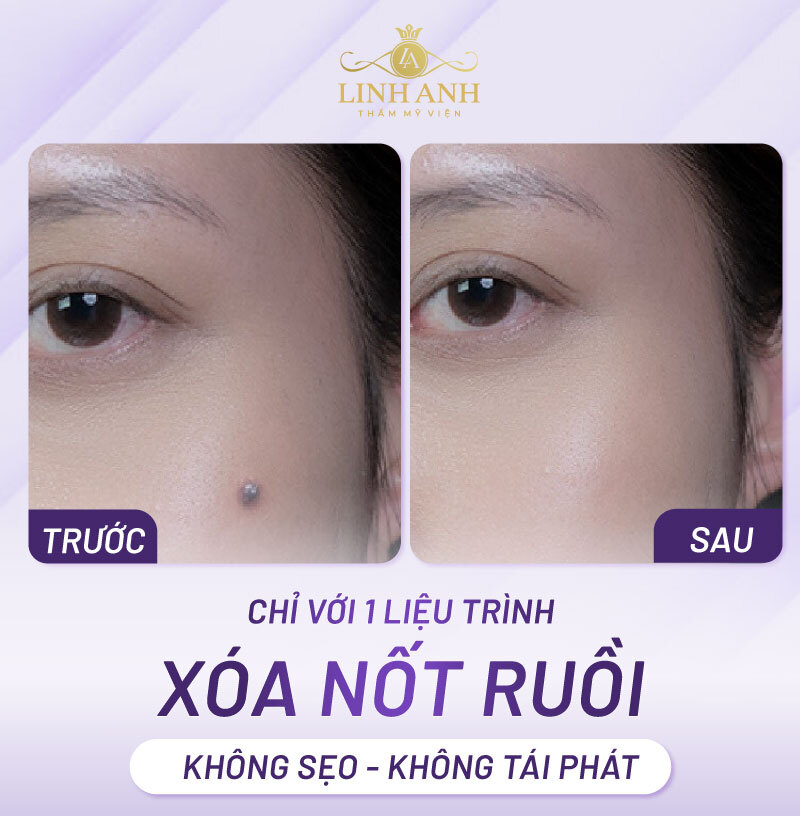 Hình ảnh tẩy nốt ruồi tại Linh Anh
