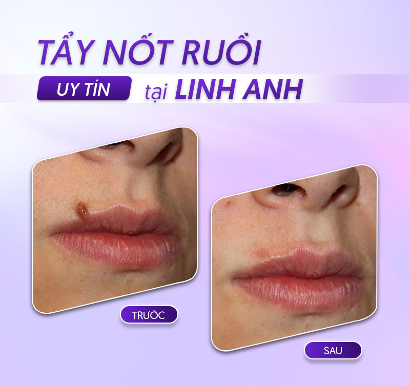 Hình ảnh trước sau khi tẩy nốt ruồi