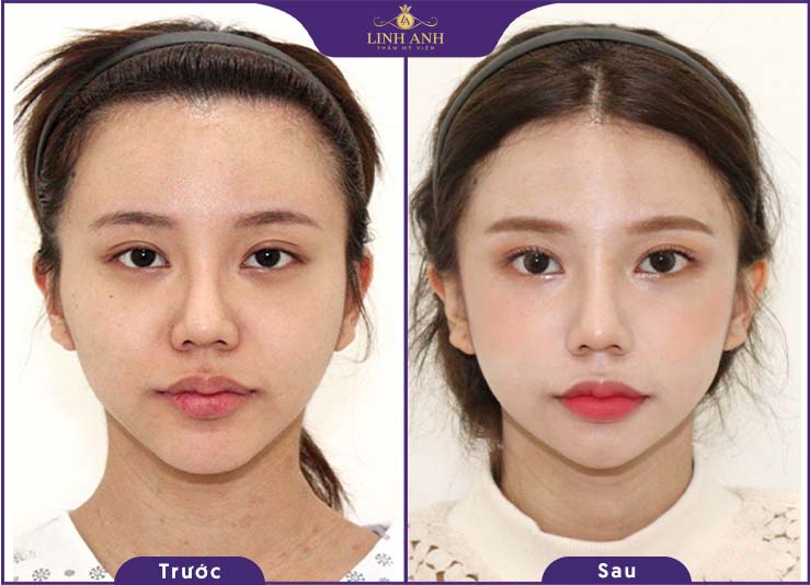 Hình ảnh trước và sau khi độn thái dương